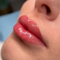 Lip Pigmentation